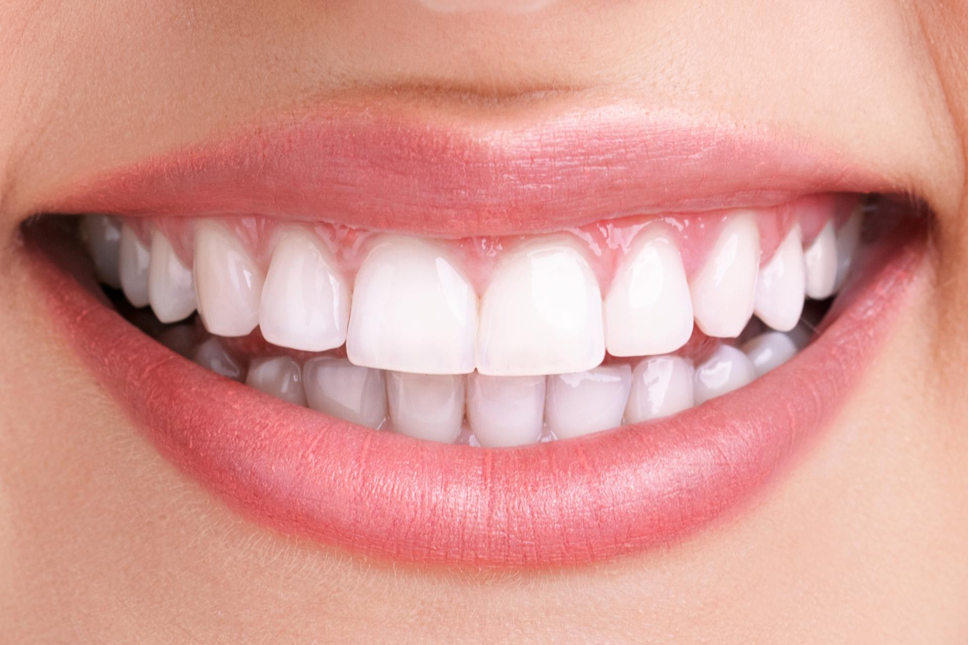 teeth-whitening-after-1