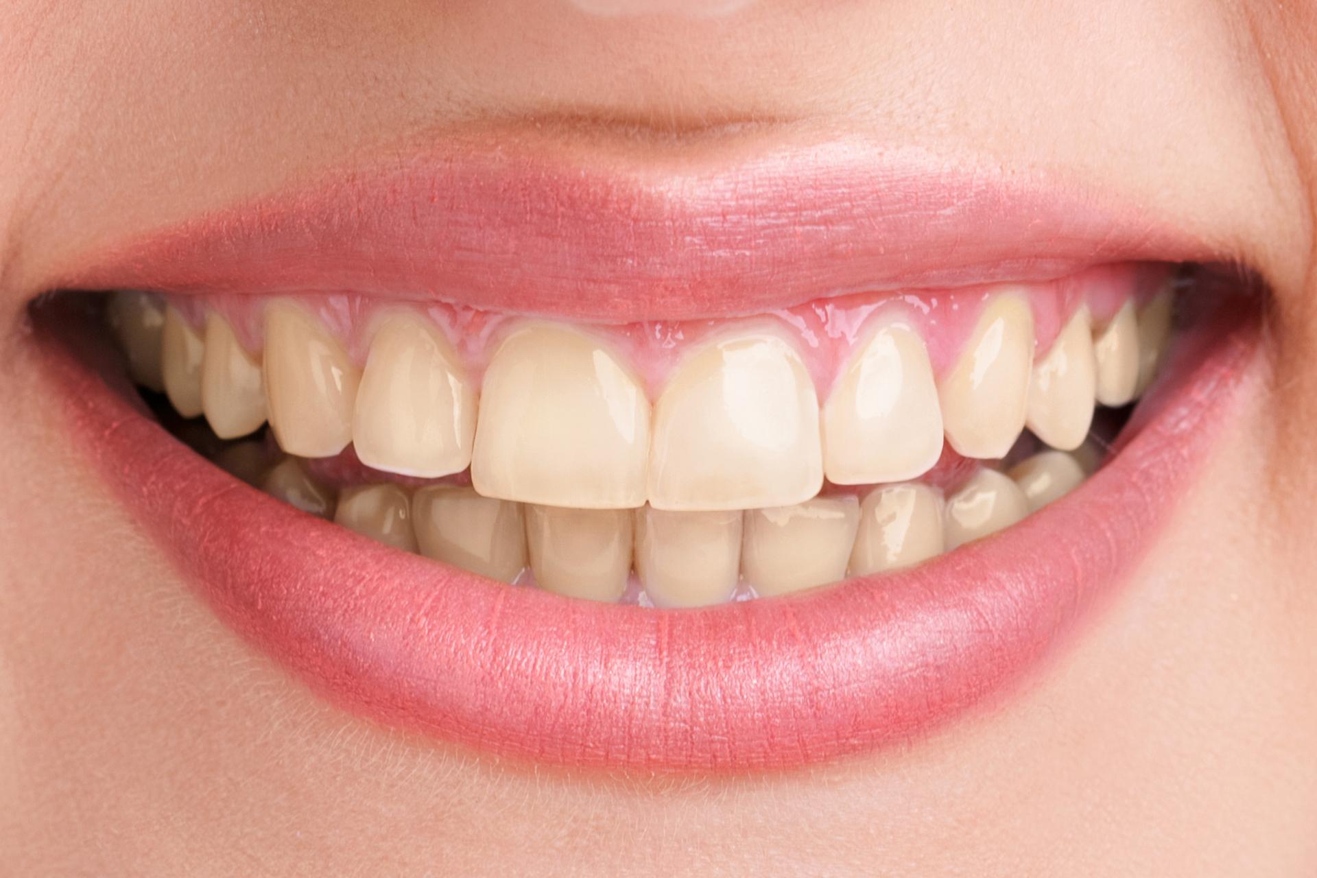 teeth-whitening-before-1 teeth-whitening-before-1